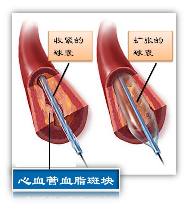 什么是球囊?(圖1) 什么是球囊?(圖1)