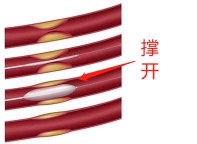 什么是藥物球囊?(圖2) 什么是藥物球囊?(圖2)